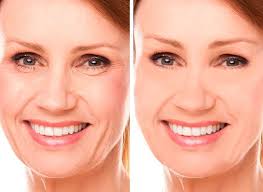 Rhytidectomy Before & After